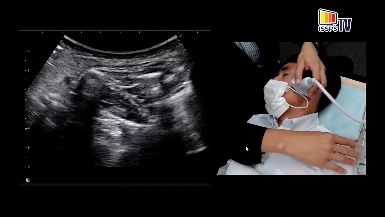 Sonoanatomy Relevant for USG Maxillary & Mandibular Nerves Block. Live Demonstration in Volunteers.
