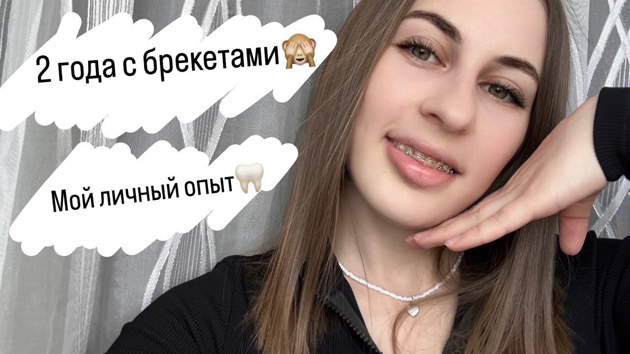 2 ГОДА С БРЕКЕТАМИ 😬 Дистальный прикус / Когда снимать? Мой личный опыт и ощущения
