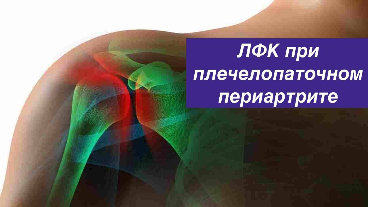 Лечебная физкультура при плече-пателлярном периартрите.
