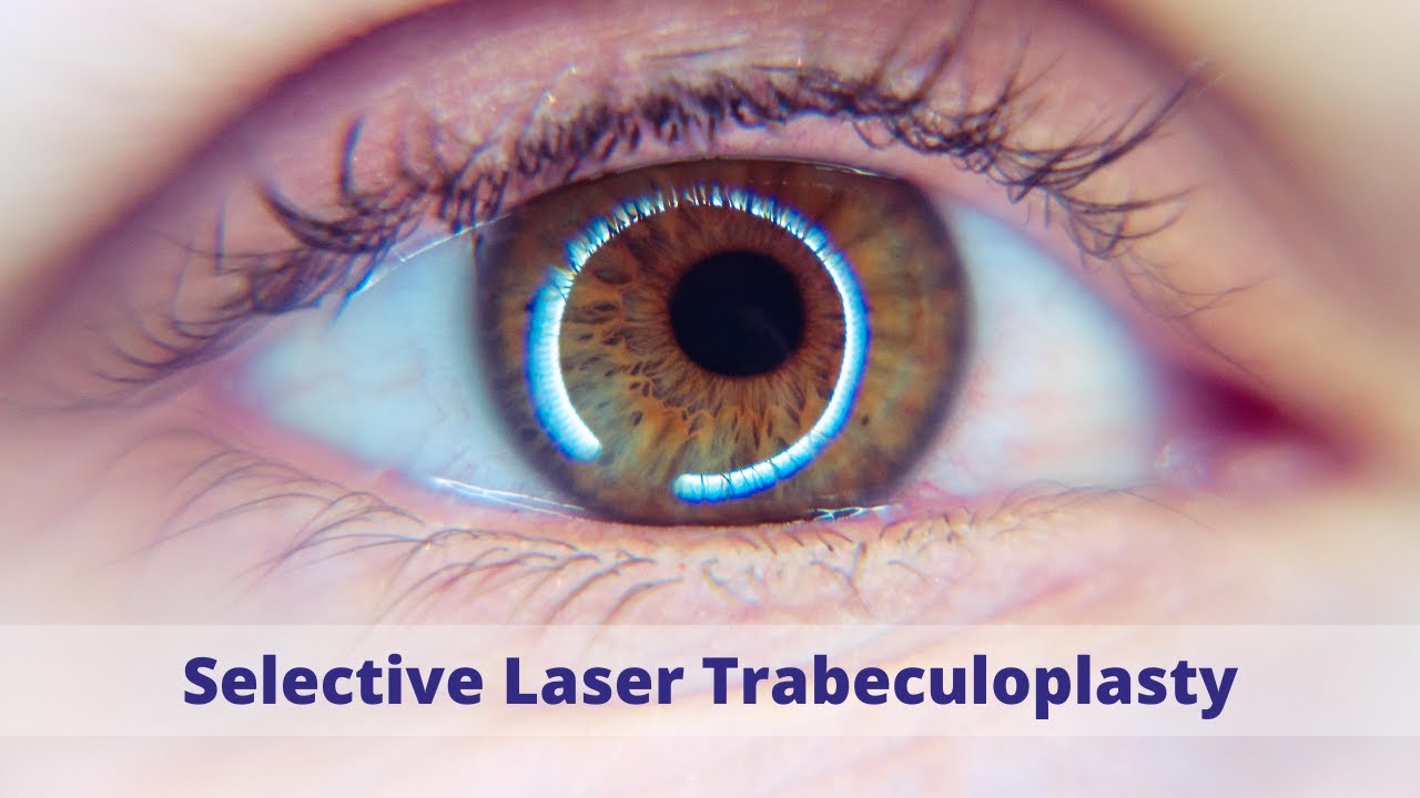 Selective Laser Trabeculoplasty