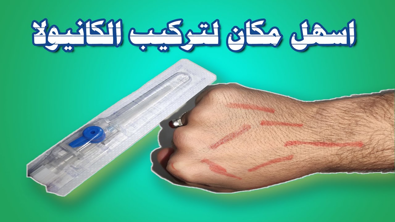 ماهي اماكن تواجد الاوردة لتركيب الكانيولا بسهولة ؟