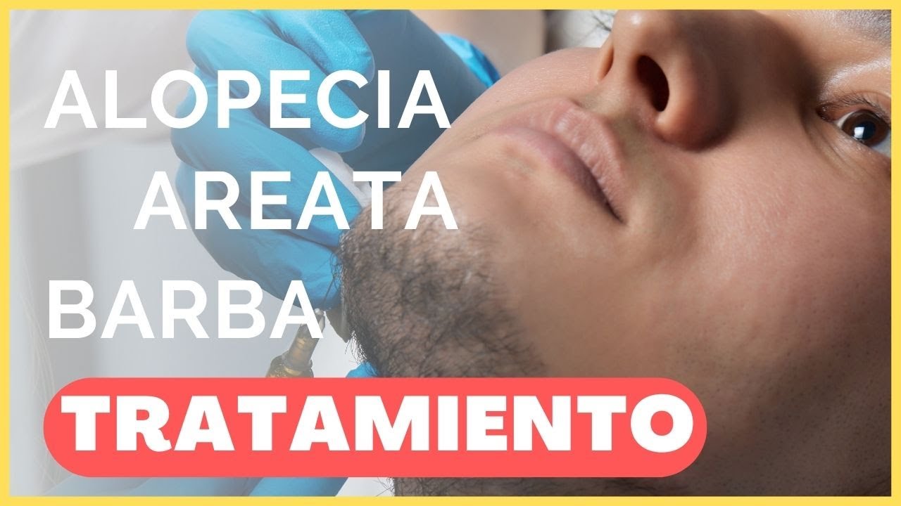 Alopecia AREATA en la BARBA ✅ LOS MEJORES TRATAMIENTOS