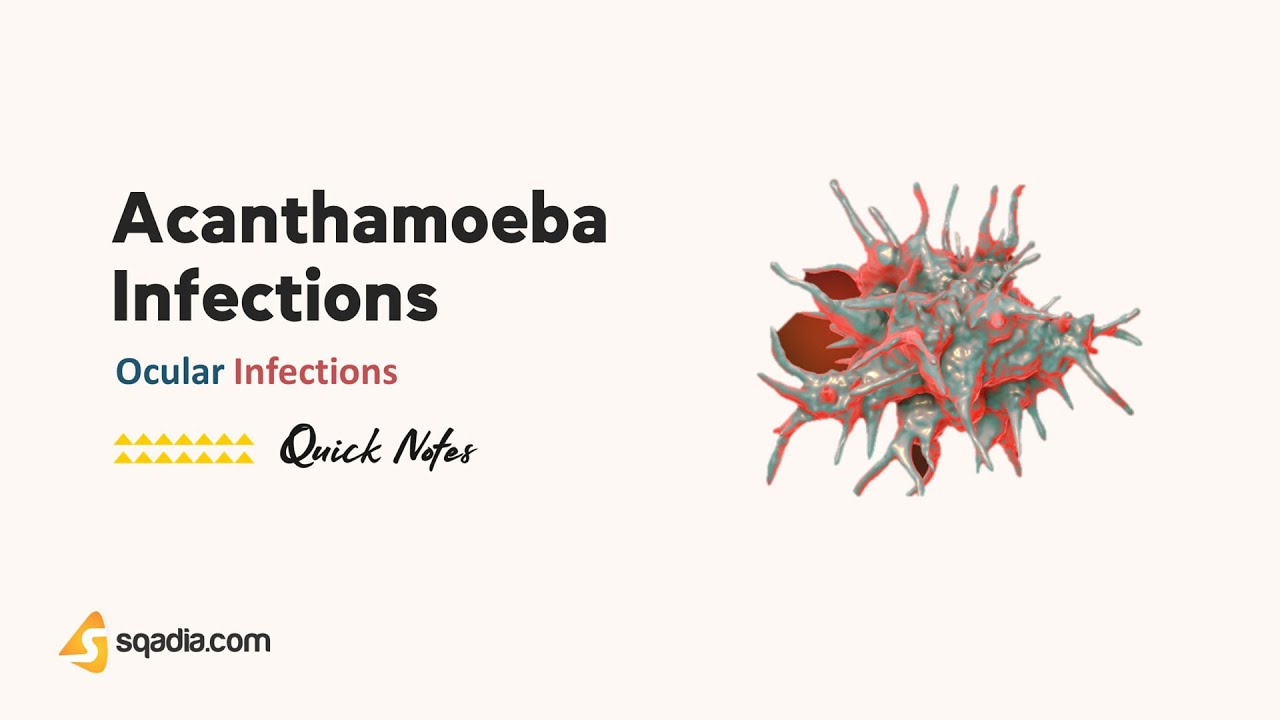 Ocular Infections | Acanthamoeba Infections