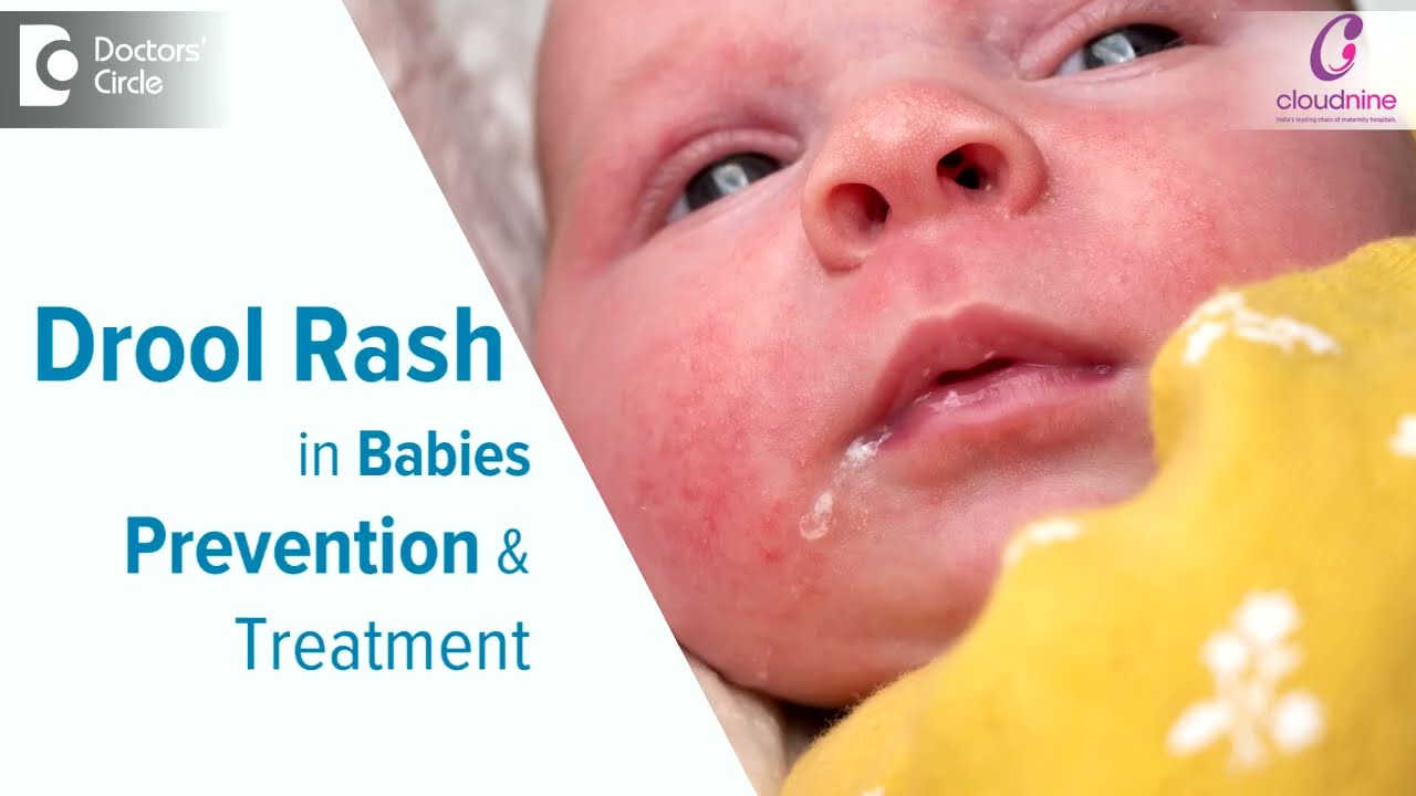 DROOL RASH IN BABIES : Causes & Treatment I Dr. Spoorti Kapate I Cloudnine Hospital