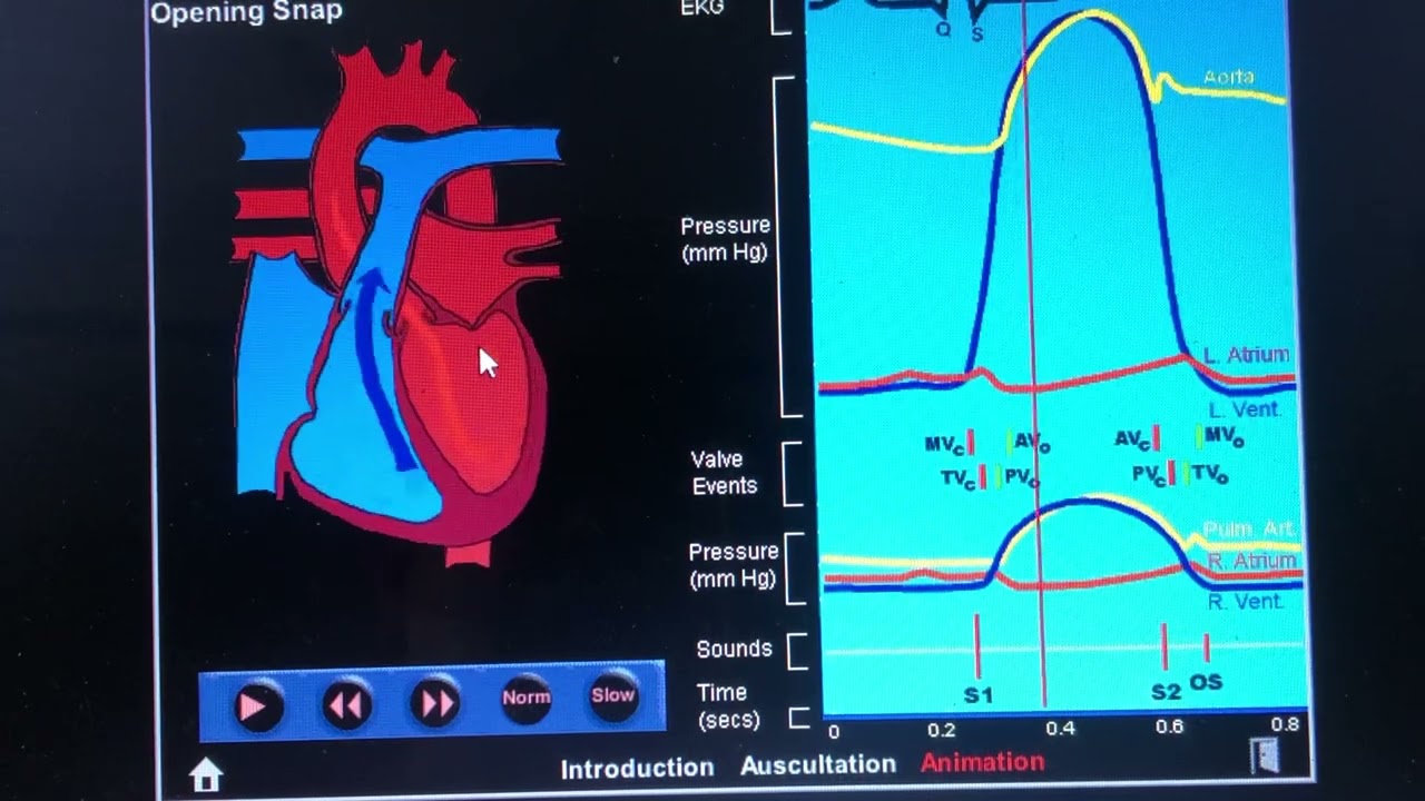 Desdoblamiento del 1er y 2do ruido. Cardiac software EKG. Algunas causas