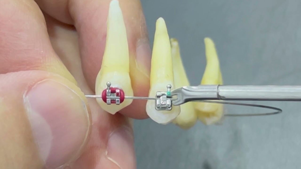 Self ligating braces  VS Traditional for both types metal #braces & #ceramic_braces #damonbraces