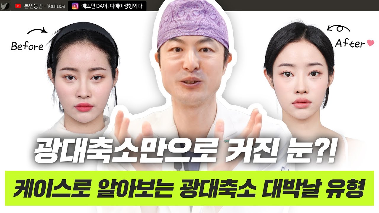광대 축소하면 대박 나는 얼굴 유형은 따로 있다? ㅣ디에이성형외과