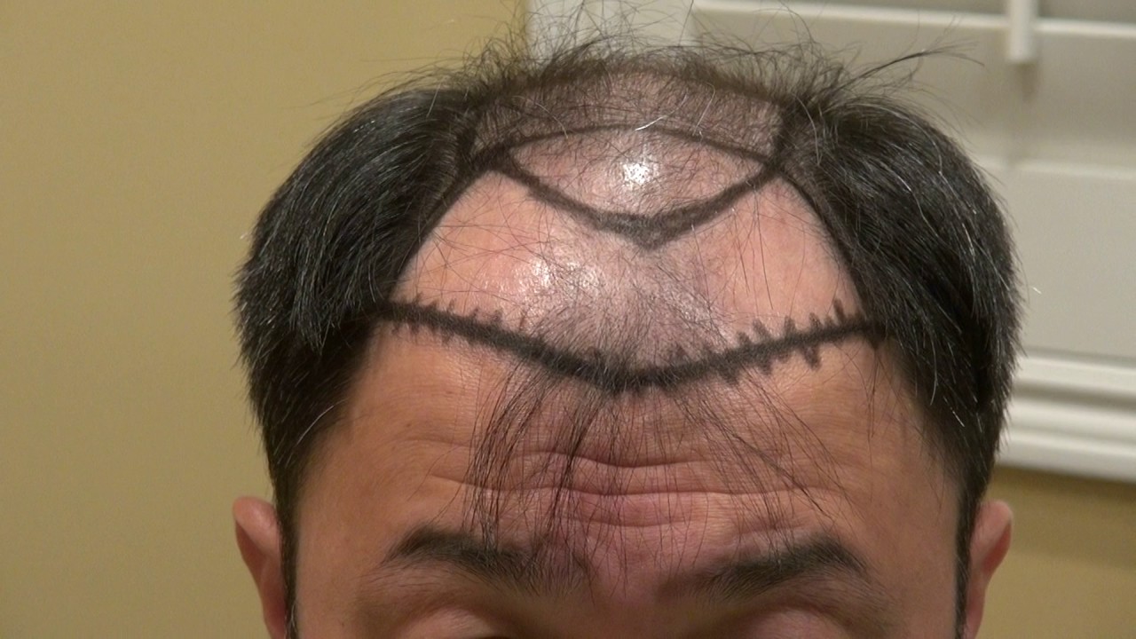Advance Bald Hair Loss Surgery Treatment Hair Transplant Restoration Diep 