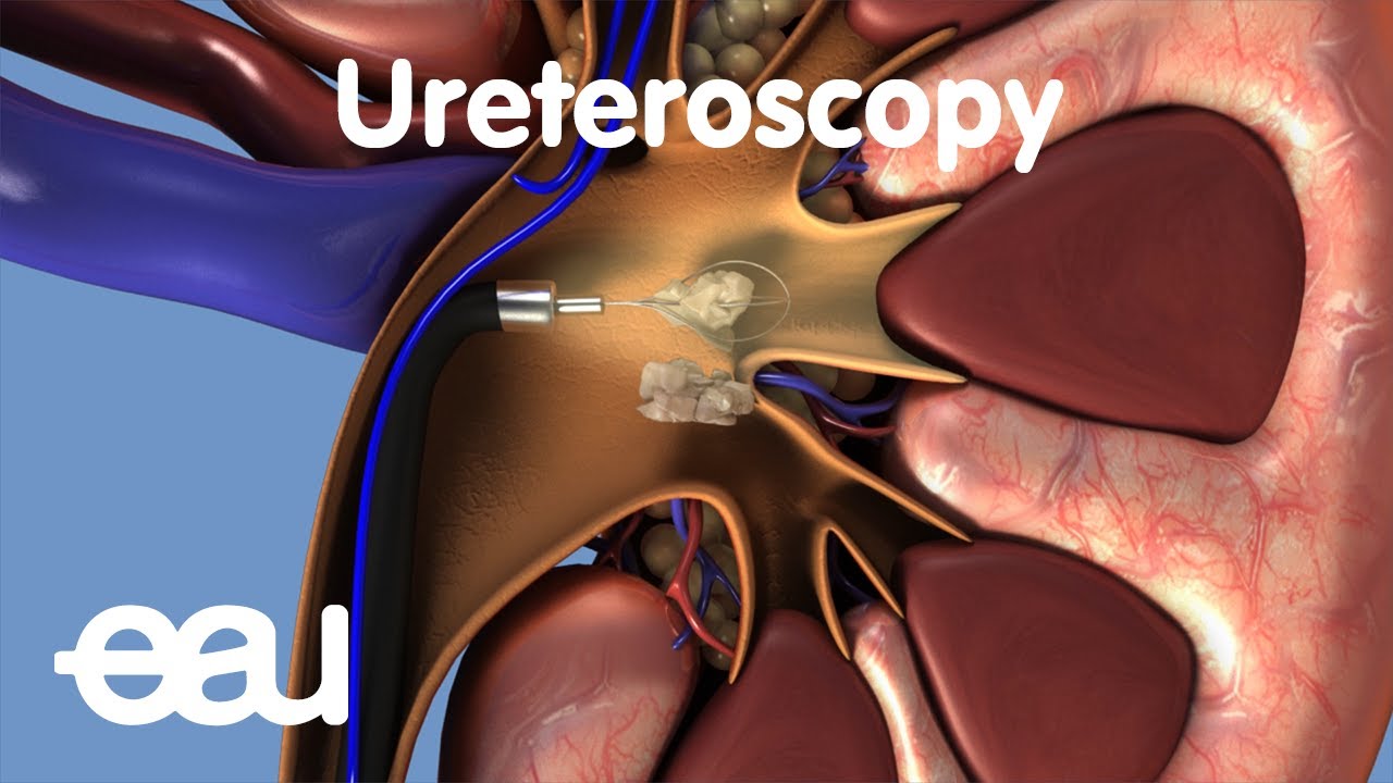 Removal of kidney stones: URS