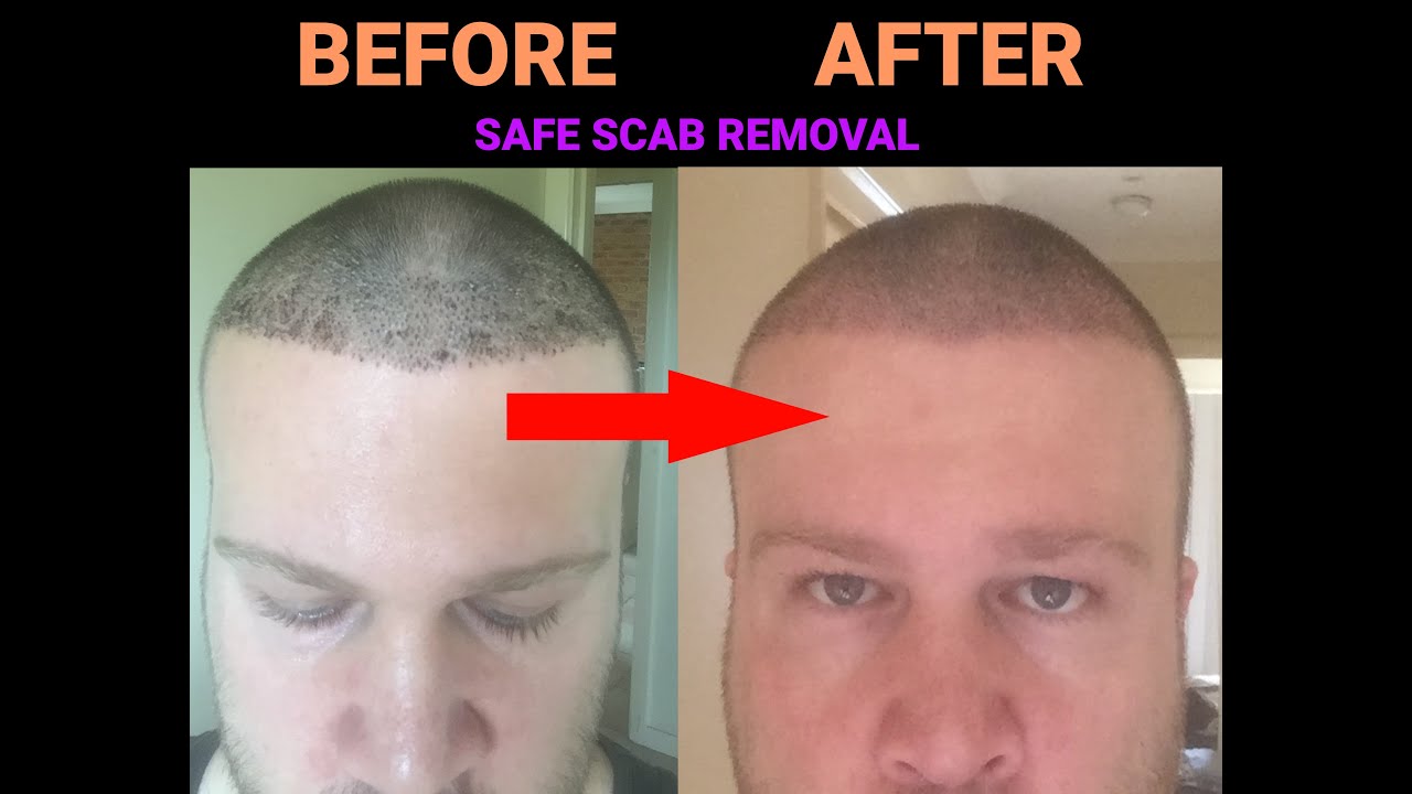 How to - Removing scabs after a hair transplant