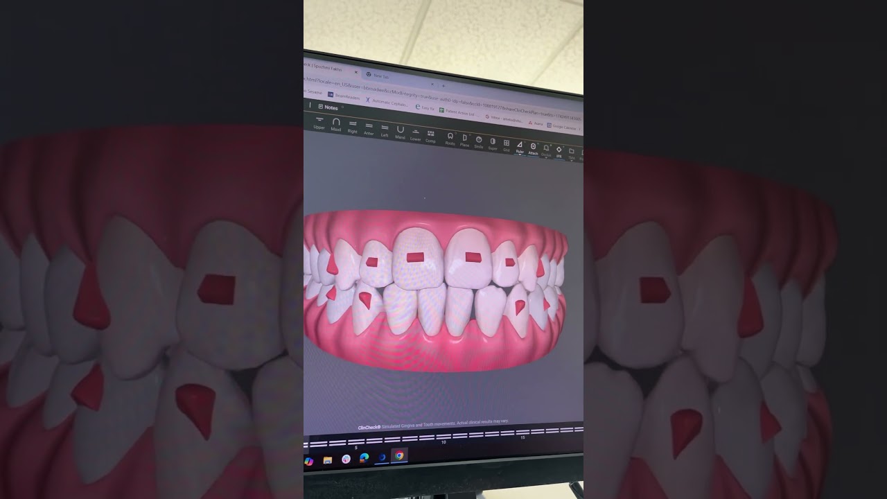 #invisalign simulation of my teeth as I go through the different clear alinger sets 🦷⚙️