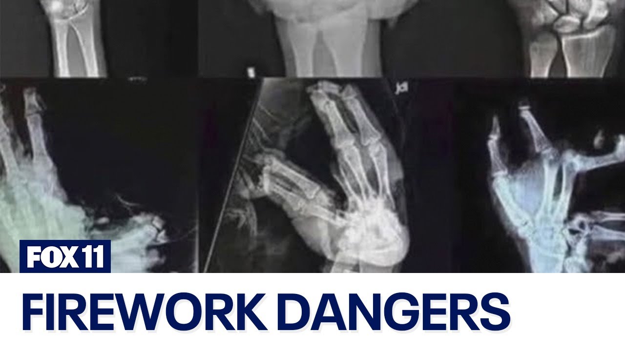 The dangers of fireworks