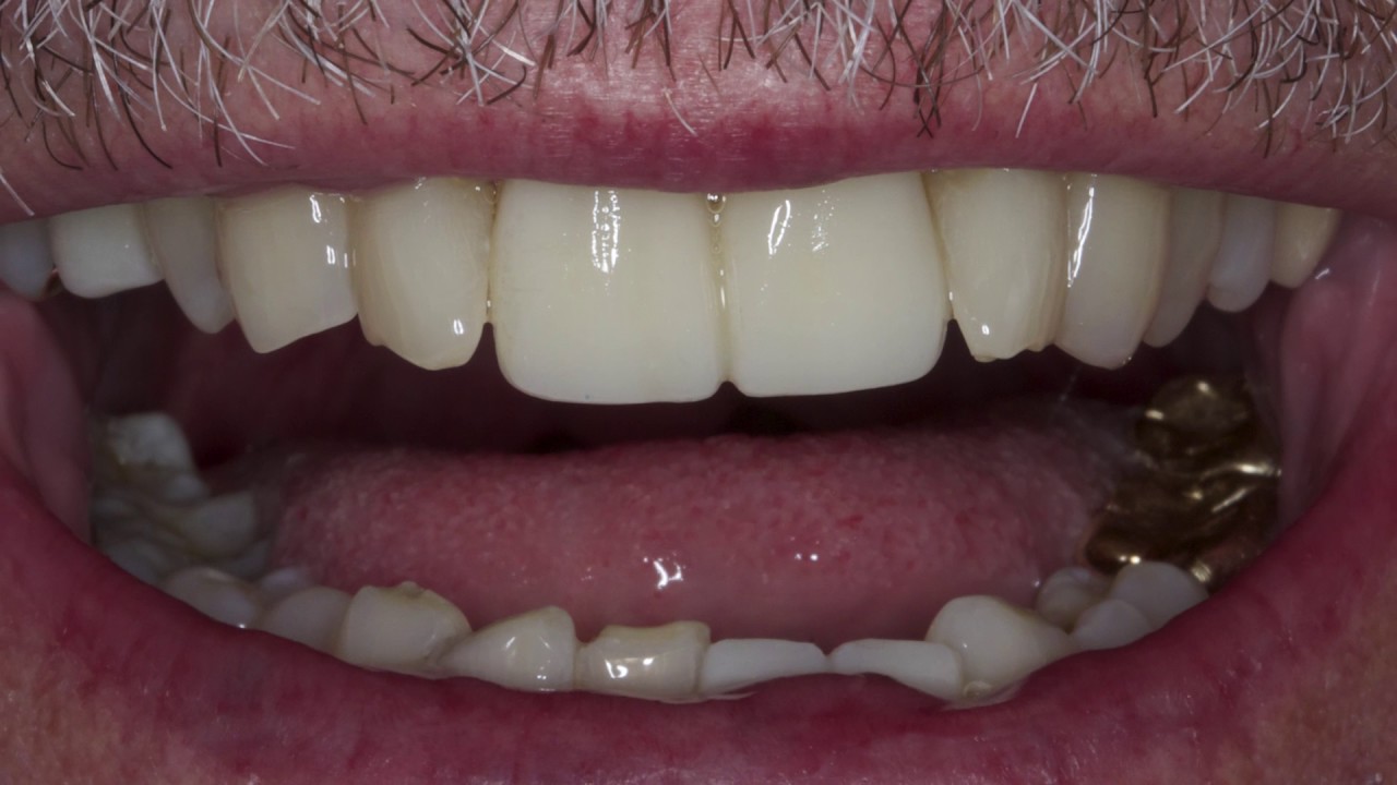 Ersatz von alten PFMs durch BruxZir® Anterior-Kronen