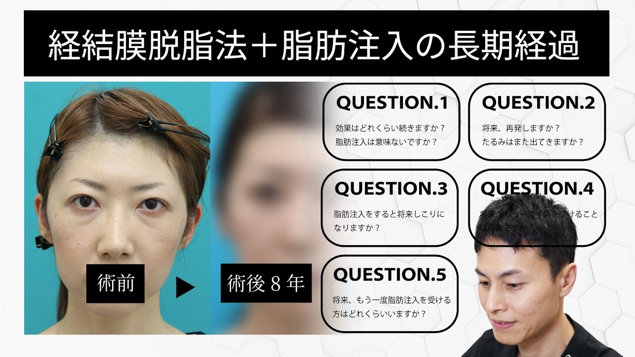 【目の下のクマ・たるみ】脱脂＋脂肪注入の長期経過　10年後は大丈夫？