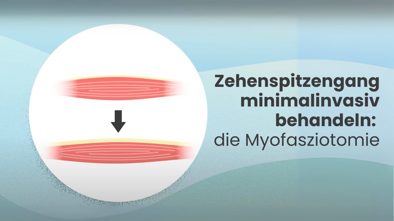 Zehenspitzengang bei Kindern: Sanfte OP-Methode erklärt (Myofasziotomie)