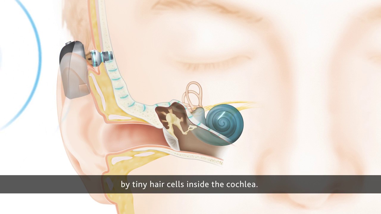 Cochlear&trade; Baha&reg; Connect System - How It Works