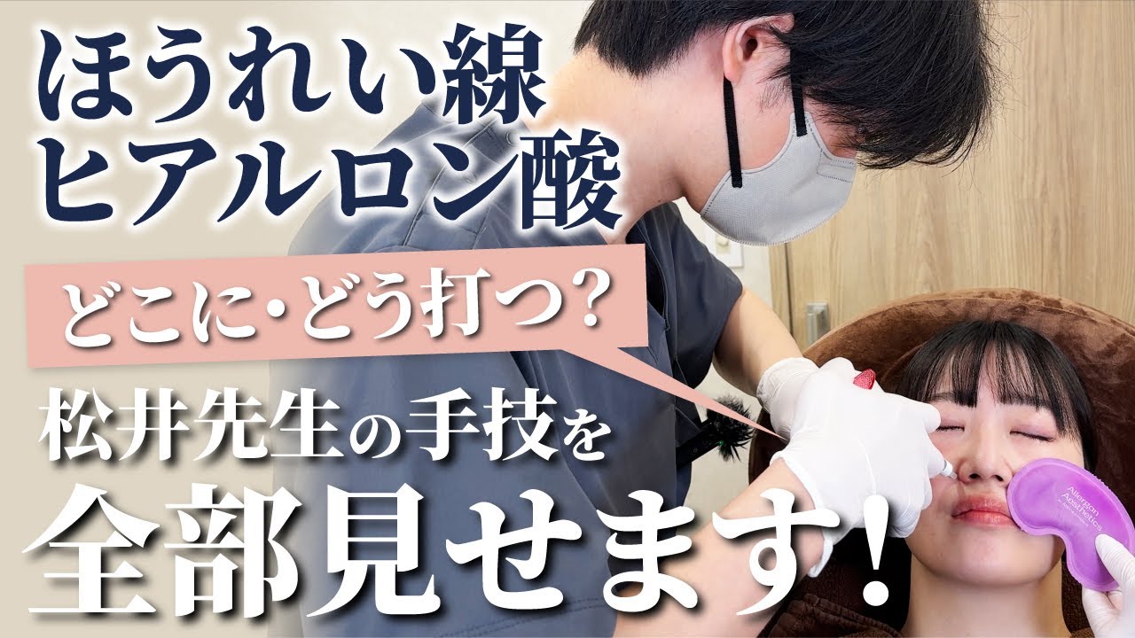 ほうれい線ヒアルロン酸、どこに・どう打つ？　松井先生の手技を全部見せます！