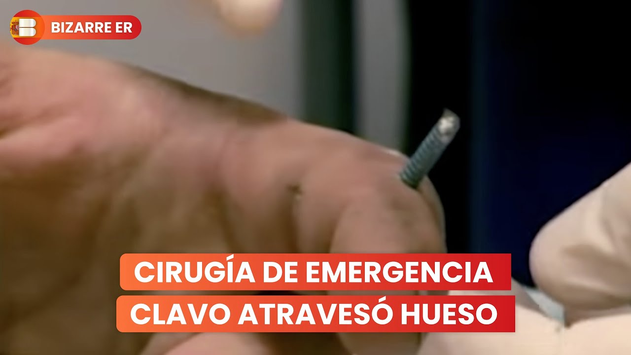 Emergencias Bizarras Pistola Clavos Dedo Perforado