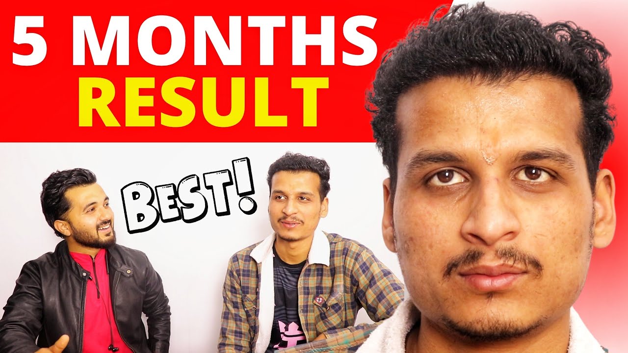 Ayushman's 5-Month Hair Transplant Result | Natural Look & High-Density Transformation!