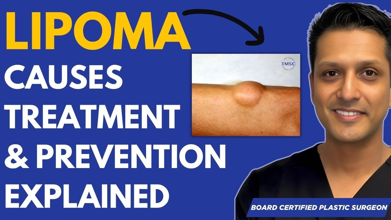 What Is A Lipoma? Explanation, Causes & Treatments