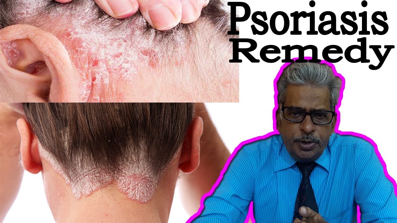 Psoriasis in Hindi - Discussion and Treatment in Homeopathy by Dr P.S. Tiwari