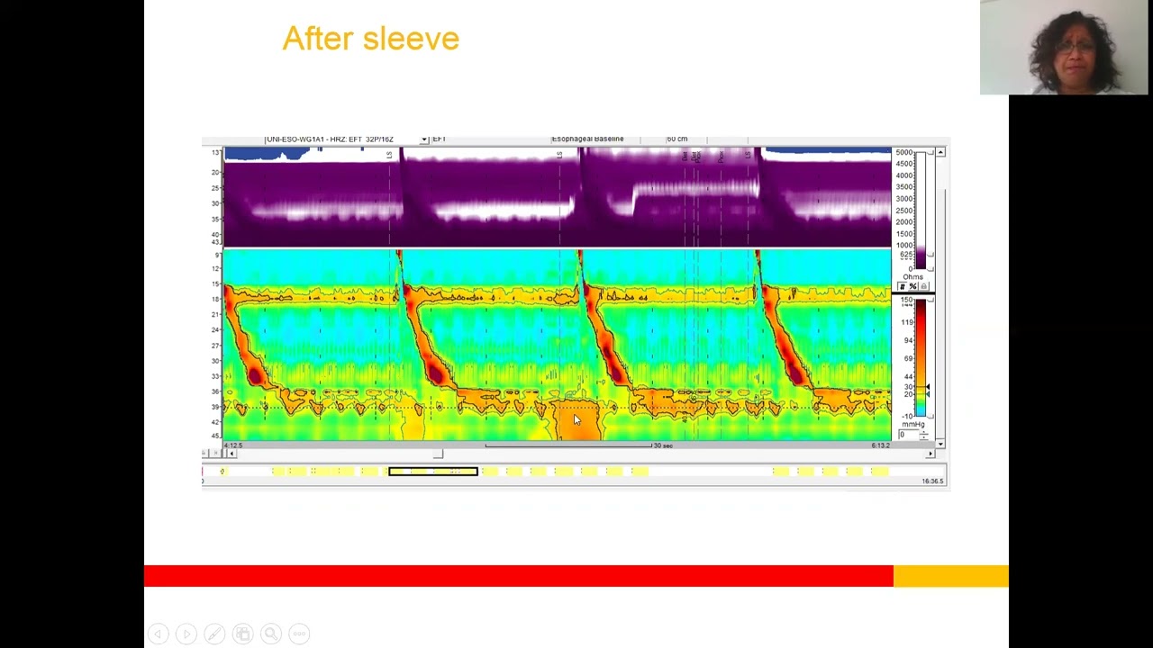 Achalasia vs EGJ Outflow Obstruction: How Can Manometry Guide Management