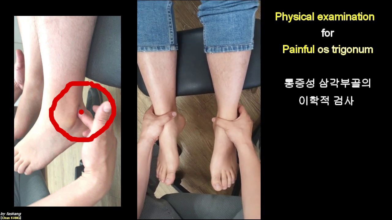 196.(의사용.Physical exam) Painful os trigonum. 통증성 삼각부골[삼각부골 증후군] [강찬.충남대.Chan KANG]