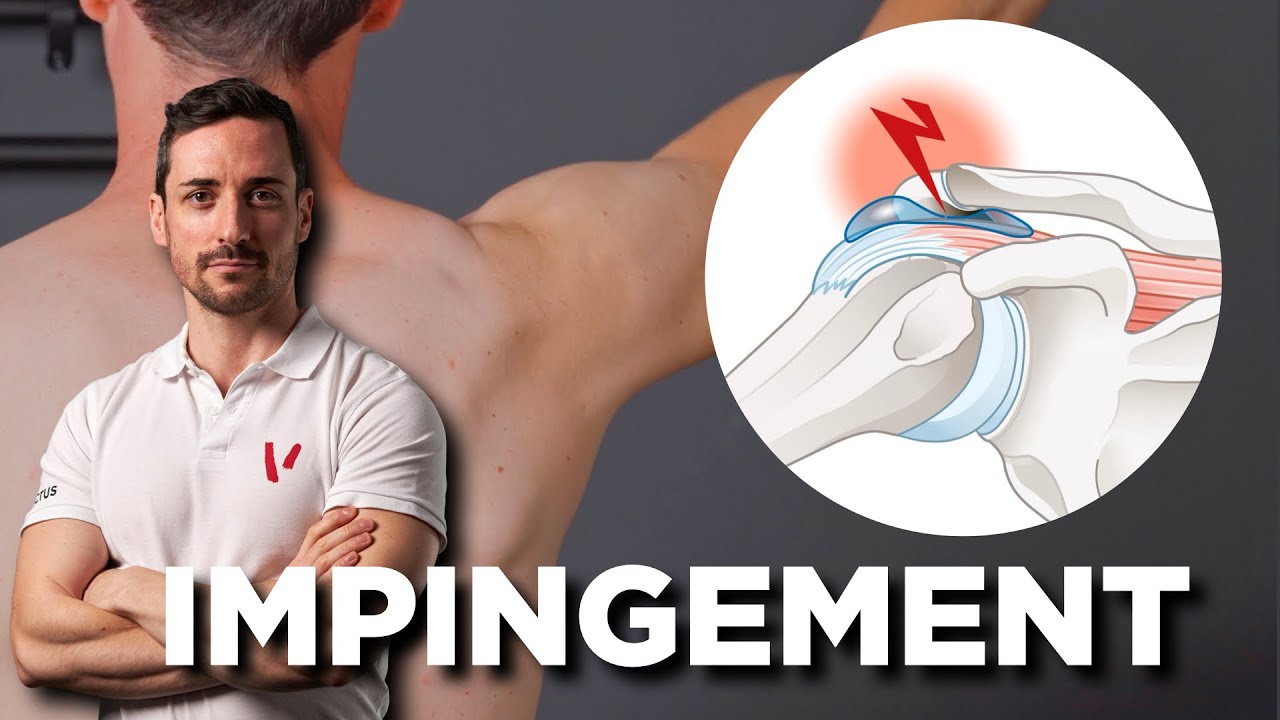 Impingement della spalla - Tutta la verità