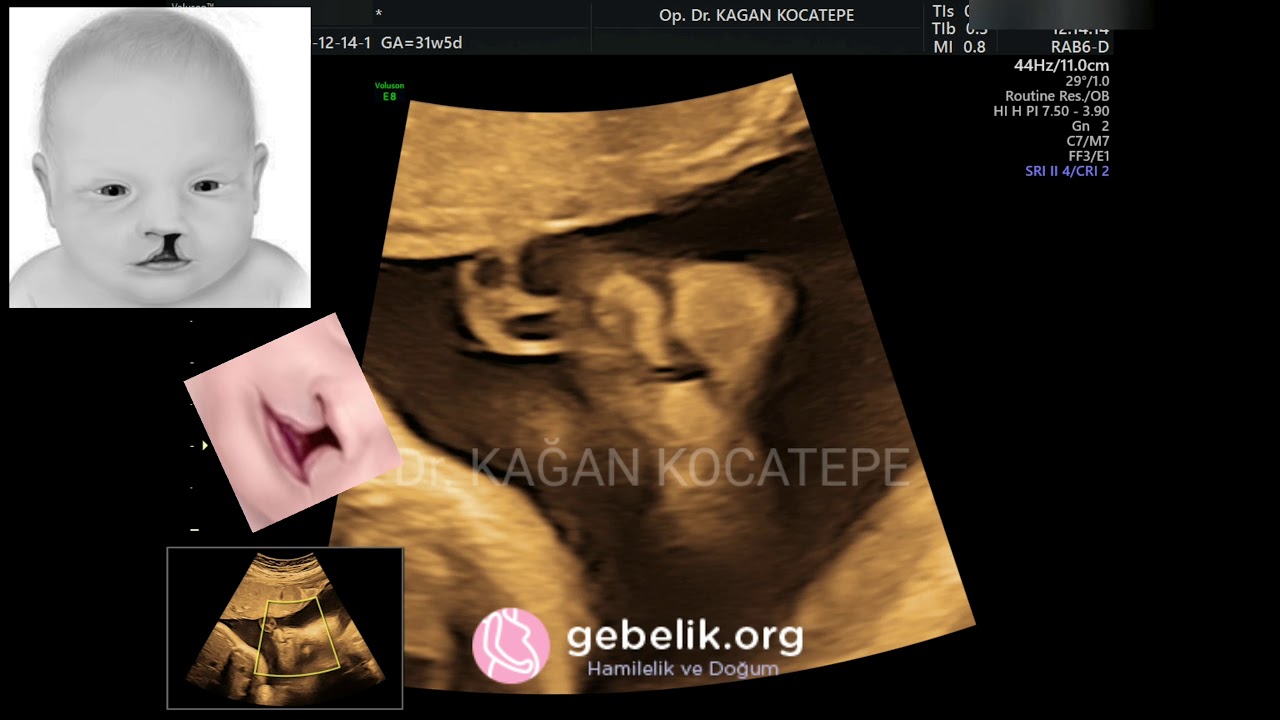DUDAK YARIĞI ULTRASONOGRAFİDE NASIL GÖRÜNÜR? (CLEFT LIP ON FETAL ULTRASOUND)