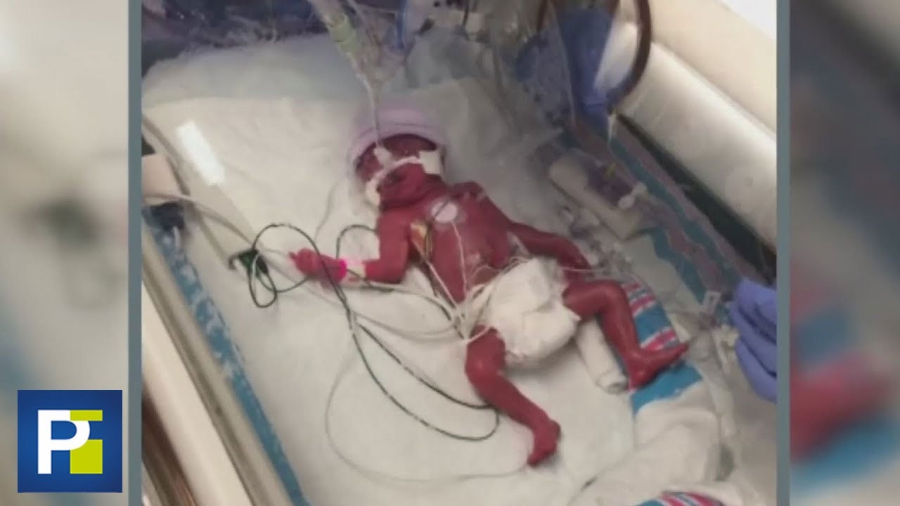 La historia de la bebé que nació a los 6 meses de gestación y pesando 1.7 libras