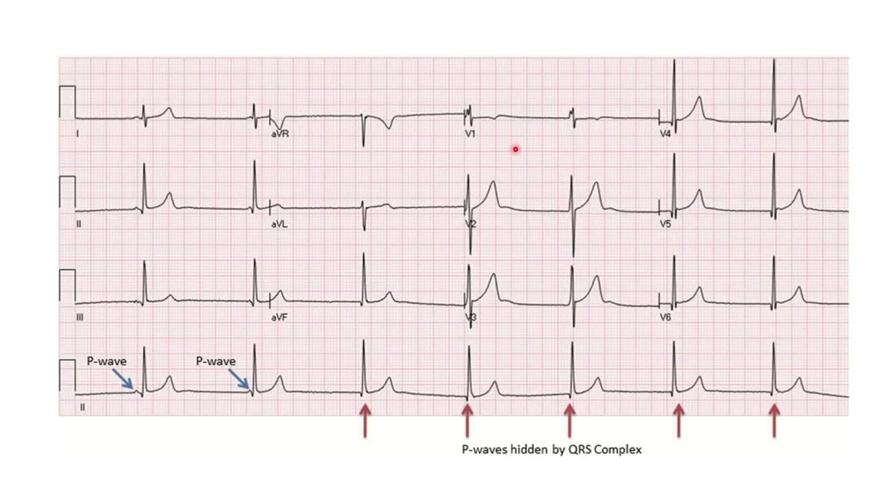 L'ECG du sportif de haut niveau + Quiz ECG Pr Nabil Berrada Maroc