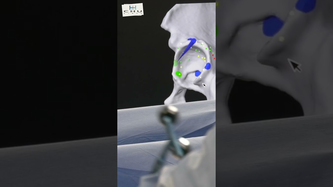 Le robot Mako passe la barre des 2000 interventions !