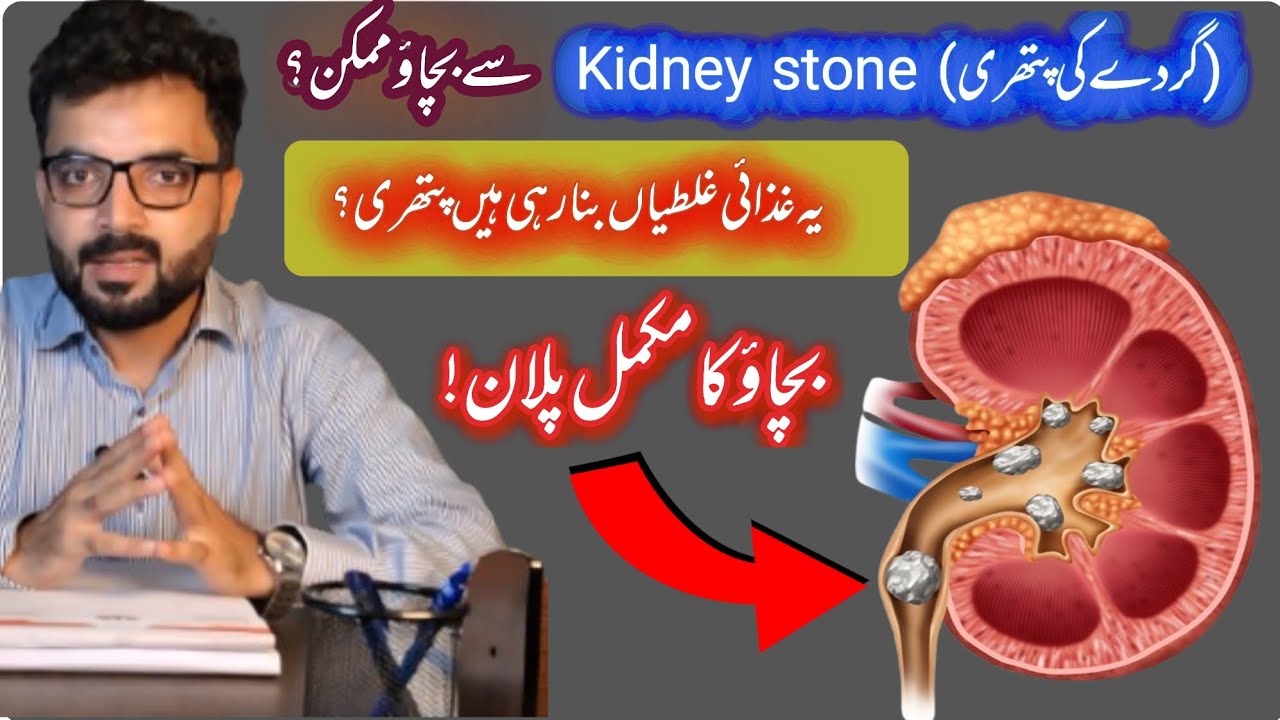 Kidney stone prevention !! | Life style Changes | Diet modifications| Urologist| Dr Ghazanfar Rafeq 