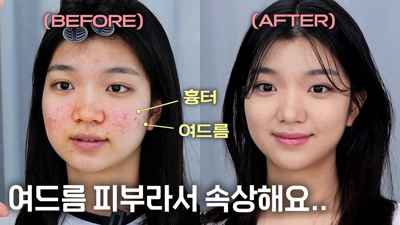 이제 대학생 되는데 여드름이 많아서 고민이에요.. 제 여드름도 커버가 되나요?