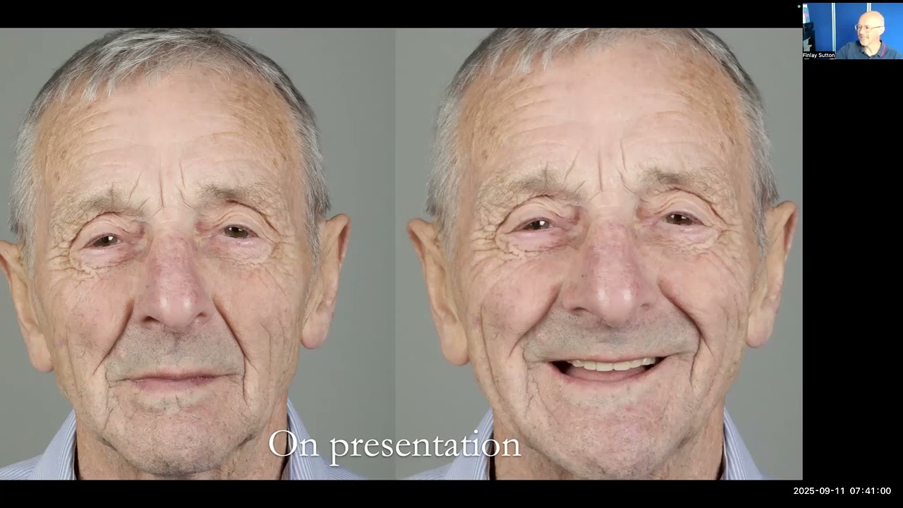 Finlay Sutton Complete Denture Case – Patient Who Never Wore a Lower Denture Before Study Club