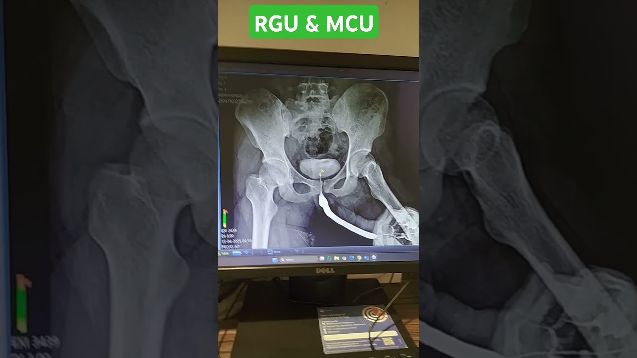 X-ray RGU & MCU test for Difficulty in urination !