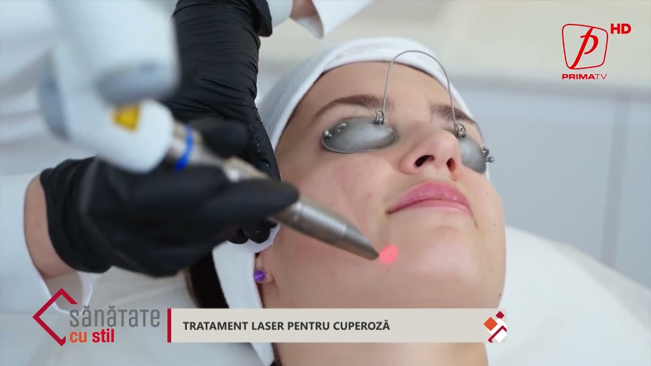 Sănătate cu stil - Tratament laser pentru cuperoză