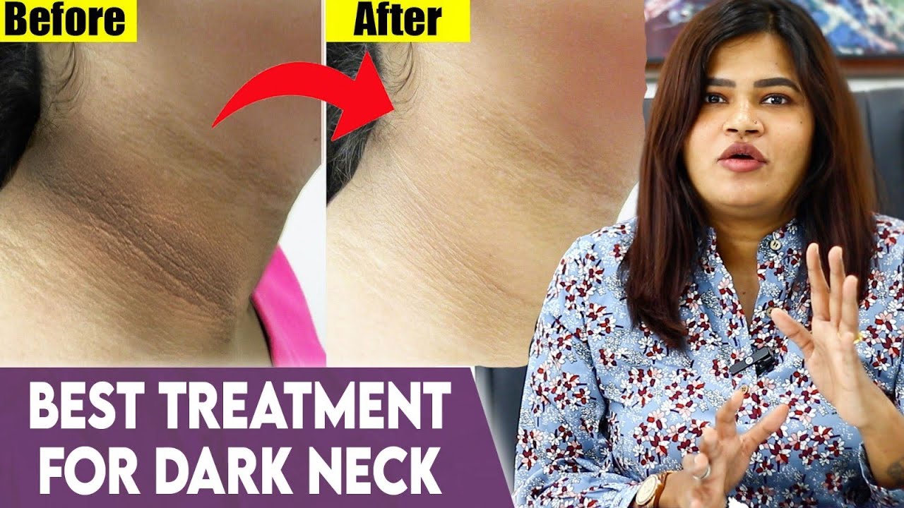 Effective Treatment For Dark Neck, Knees & Elbows! - Dr Radha Subramaniyan Explains | Pigmentation