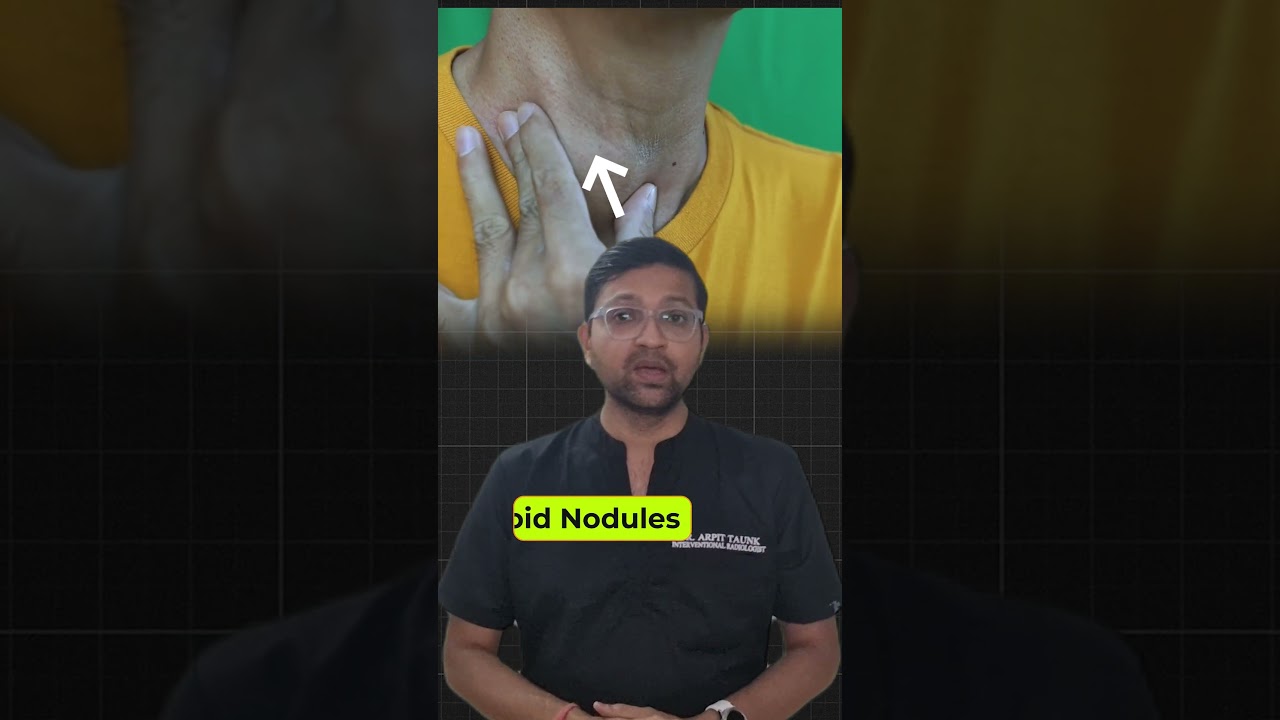Gale Me Ganth ka ilaj | Thyroid Nodule Kya Hota Hai? #thyroid #thyroidproblems