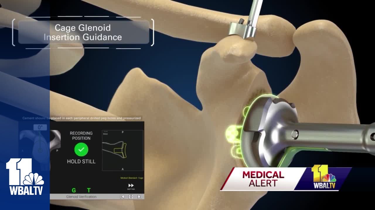 New technology makes shoulder replacement surgery much easier
