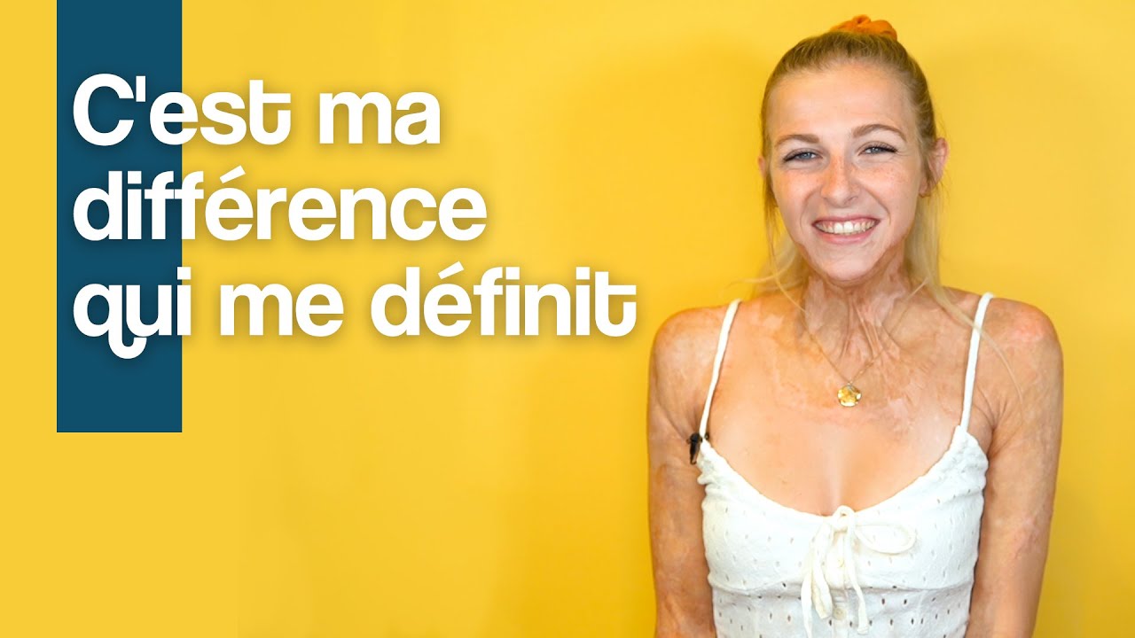 Julie Bourges, le témoignage d’une grande brûlée