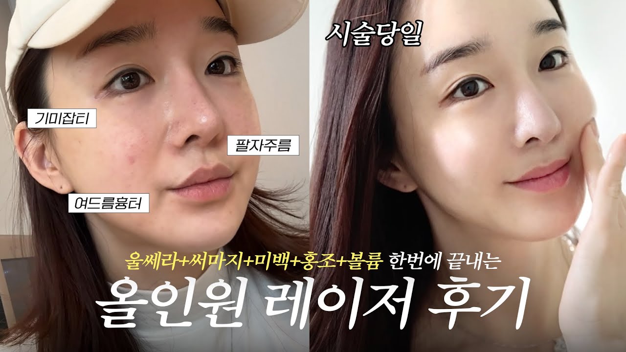 ’울쎄라•써마지•토닝‘ 모두 합친 올인원 레이저 받고 왔어요🫨 리프팅, 기미잡티, 여드름흉터, 볼패임 고민이신 분들에게 추천하는 피부과 시술!