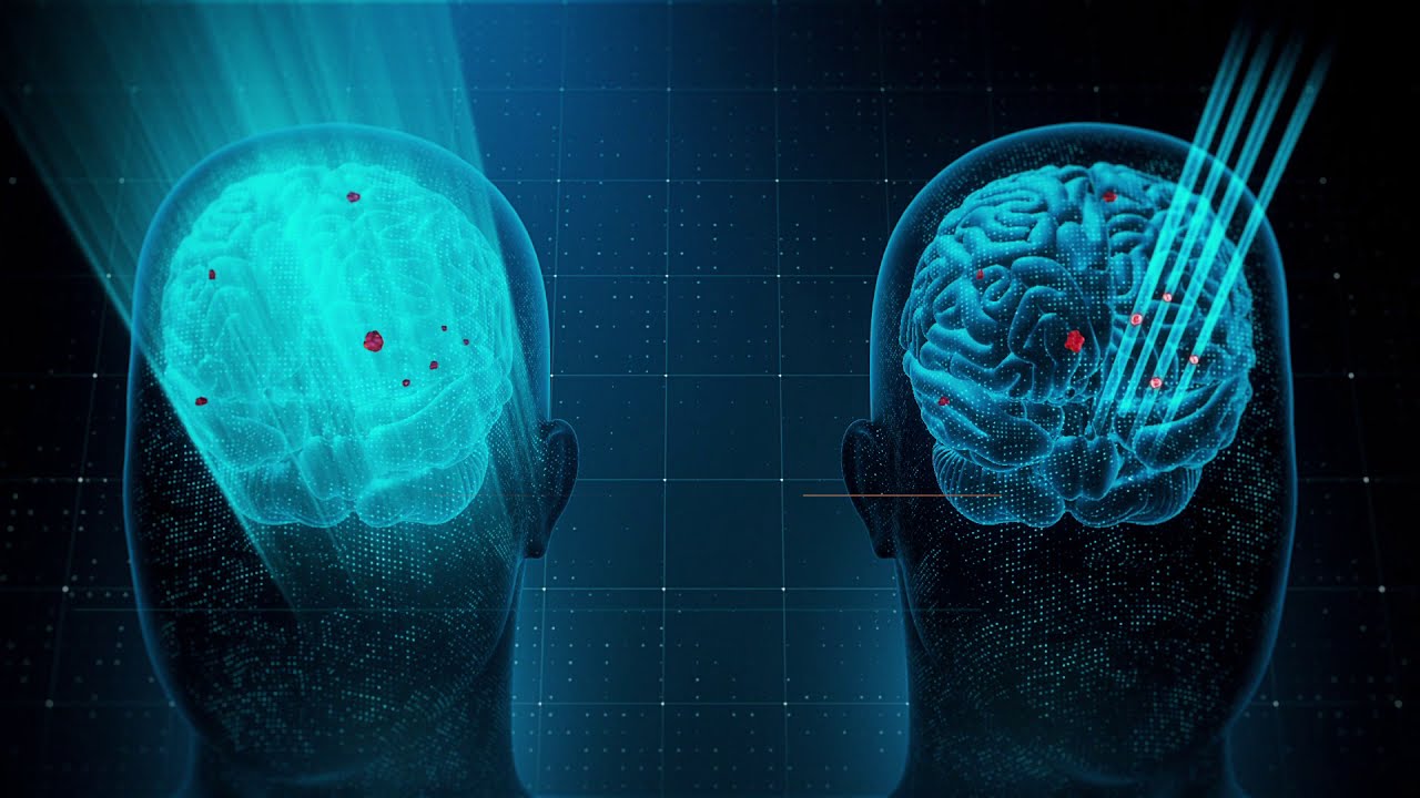 ICON Gamma Knife radiosurgery for the treatment of brain cancer (medical device 3D animation)