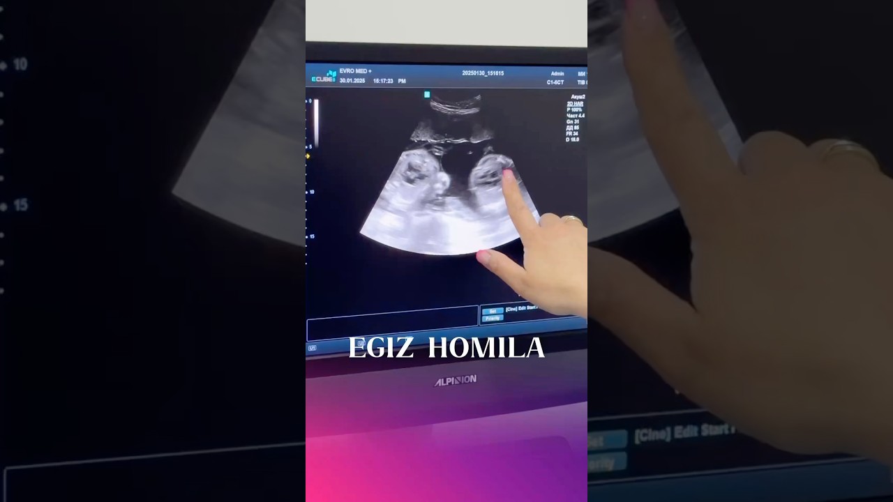 Egizak homila: qiz va o&rsquo;g&rsquo;il homila😊❤️#baby #homila #ultratovush #follikulometriya #ovulyasiya #uzi