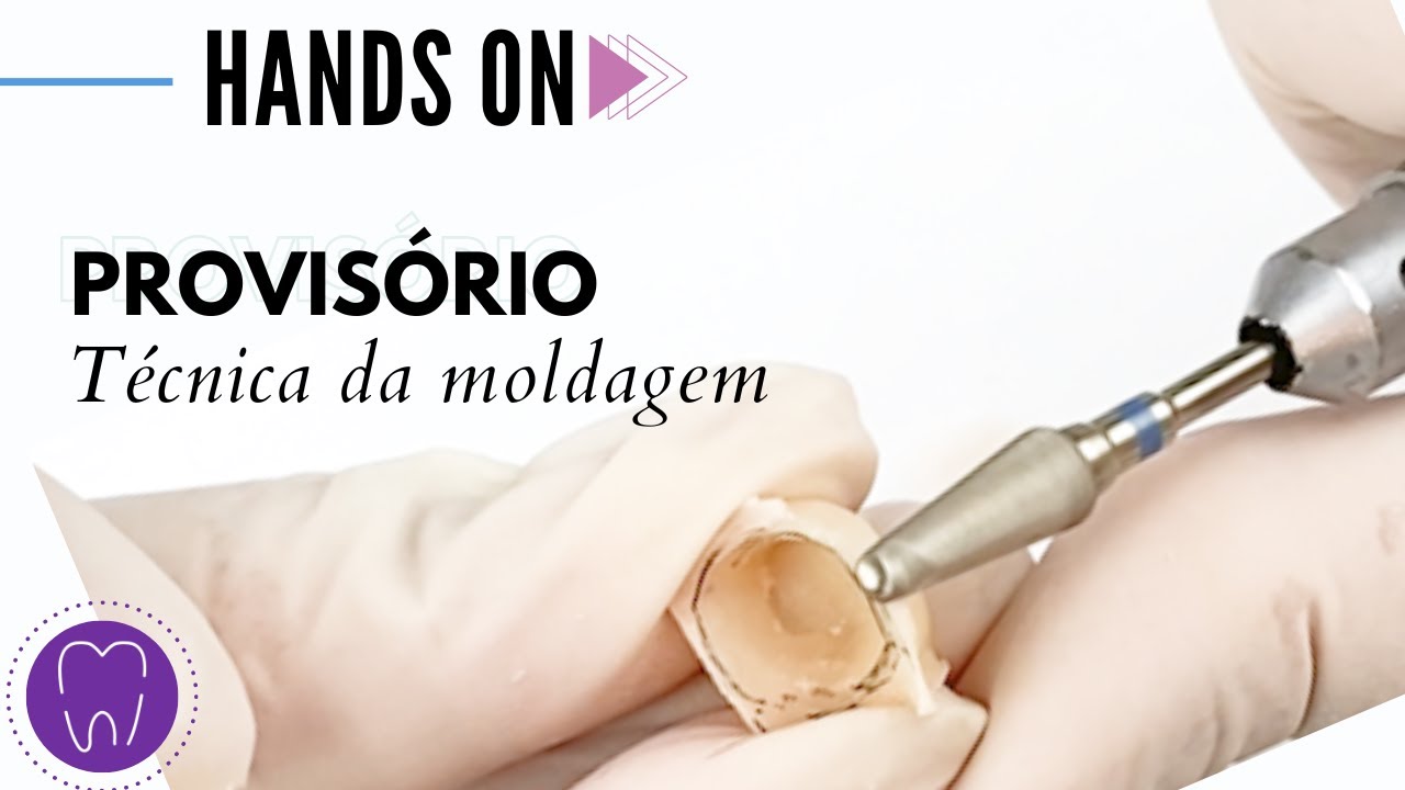 Provisório posterior | Técnica da moldagem