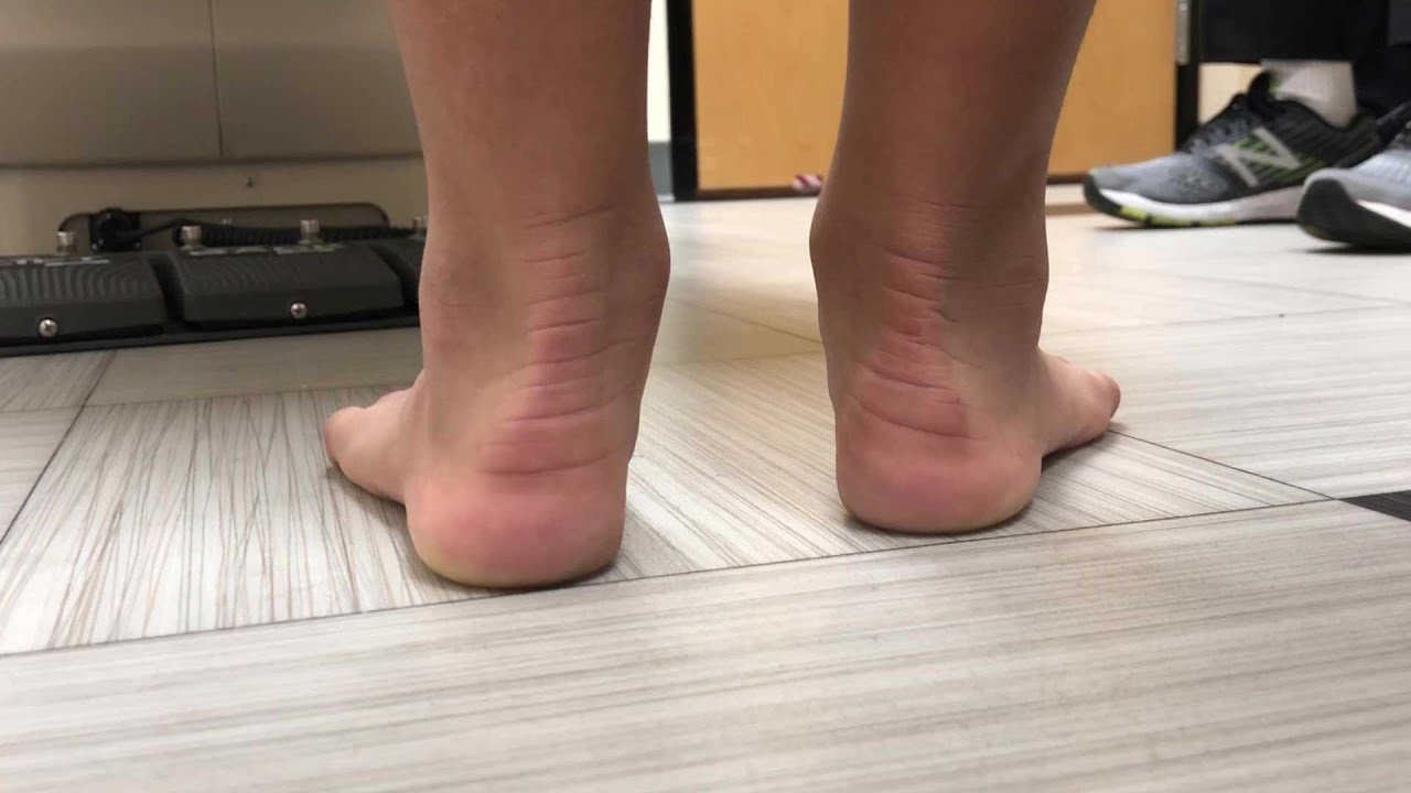 Hyprocure - Symptoms & Cure for Misaligned or Flat Feet