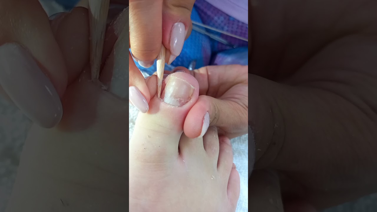 como desencravar unhas dos p&eacute;s sem machucar