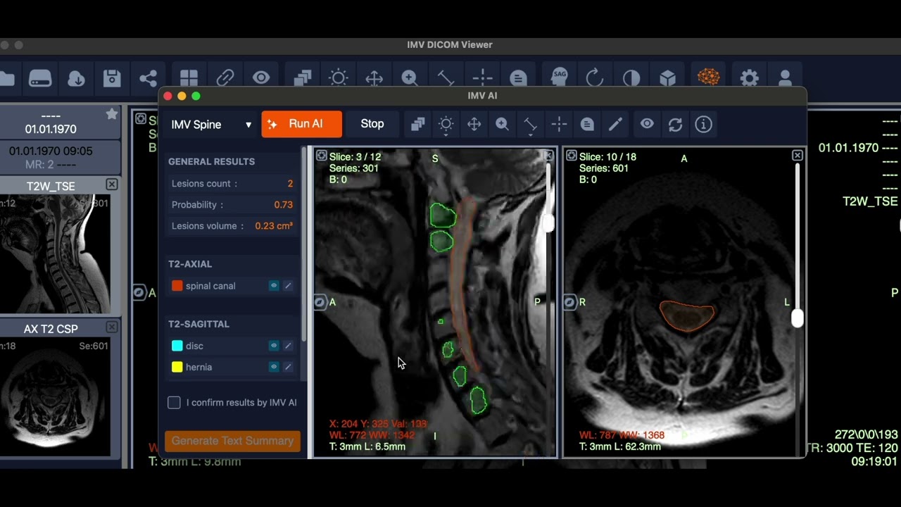 Revolutionary AI for Spine Analysis | IMV Spine