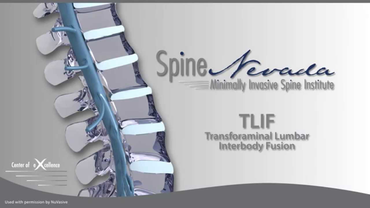 Minimally Invasive TLIF at Spine Nevada in Reno, Sparks, Carson, Sacramento