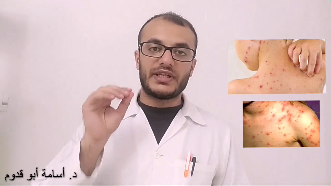 كيف تمنع ظهور الندب والاثار لدى أطفالك بعد مرض الجدري، الدكتور اسامة ابو قدوم